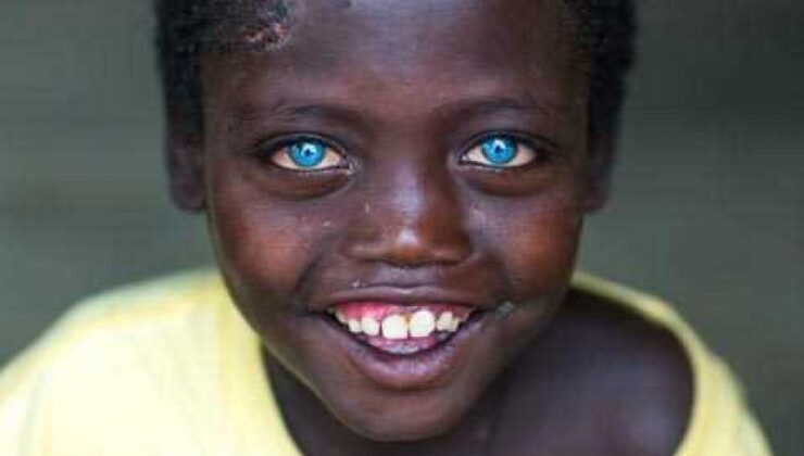 Siyahiler nasıl mavi gözlü olabiliyor?