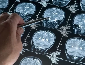 Japonya’da, Alzheimer belirtilerini saptayabilen kan testi kiti onaylandı