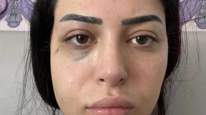 GKRY’de 25 yaşındaki Türk kızına saldıran 2 Rum tutuklandı